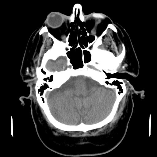 Acute hemorrhagic stroke (Radiopaedia 17507-17223 Axial non-contrast 12).jpg
