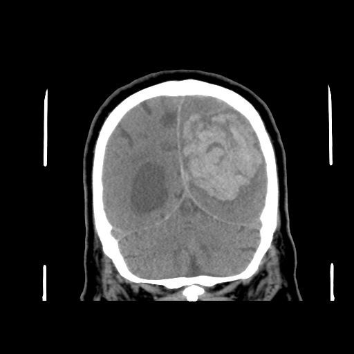 Acute hemorrhagic stroke (Radiopaedia 17507-17223 Coronal non-contrast 43).jpg