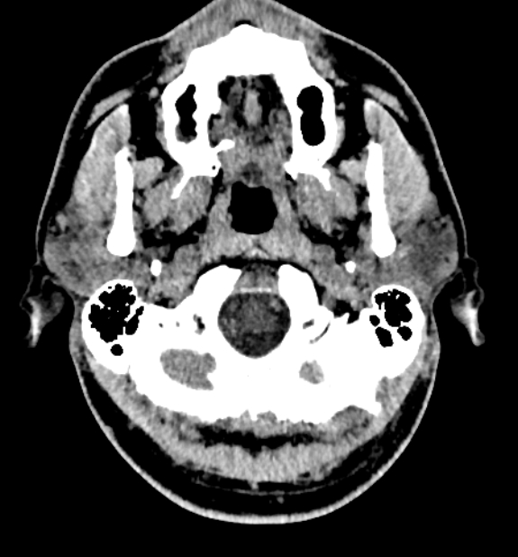 Acute ischemic stroke - posterior circulation territory (Radiopaedia 77670-89881 non-contrast 4).jpg