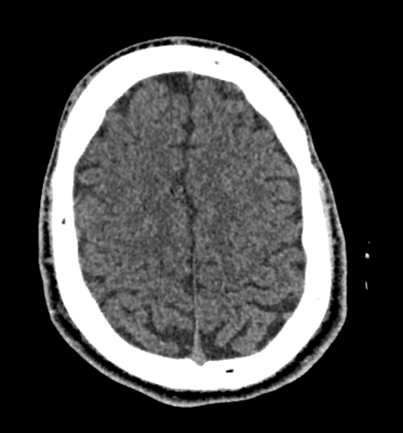 Acute ischemic stroke - posterior circulation territory (Radiopaedia 77670-89881 non-contrast 72).jpg