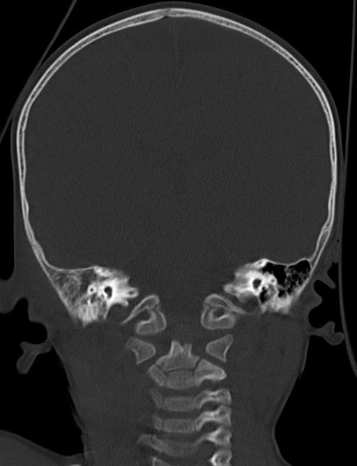 Acute mastoiditis (Radiopaedia 82678-96881 Coronal bone window 47).jpg