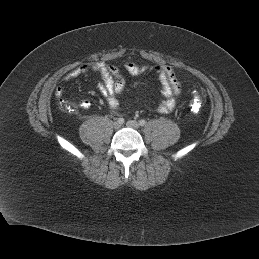 Acute mesenteric venous ischemia (Radiopaedia 46041-50383 Axial C+ portal venous phase 90).jpg