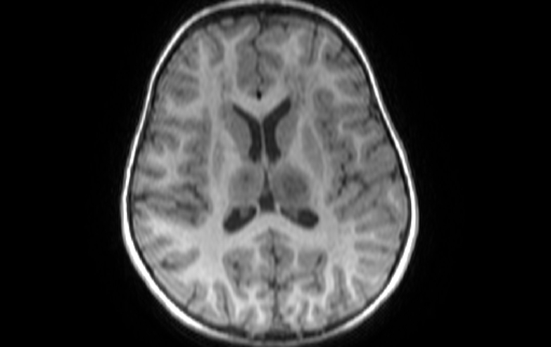 Acute necrotizing encephalitis of childhood (Radiopaedia 67356-76737 Axial T1 39).jpg