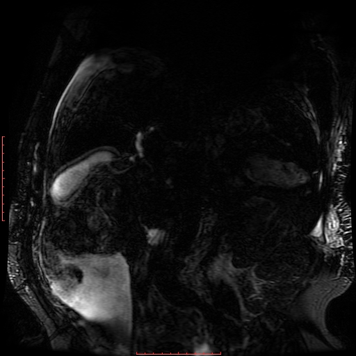 Acute necrotizing pancreatitis (Radiopaedia 28194-28448 Coronal MRCP 39).jpg