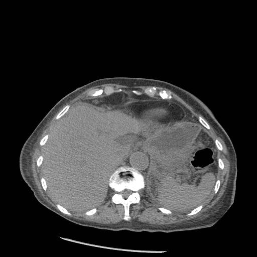 Acute on chronic pancreatitis (Radiopaedia 13233-13244 Axial non-contrast 9).jpg