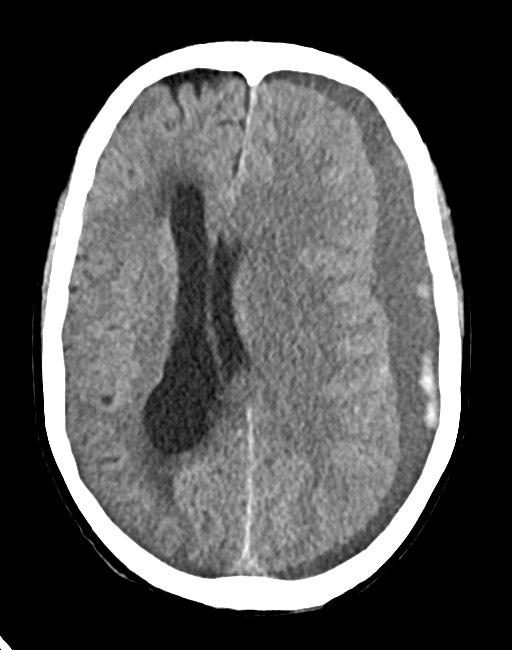 Acute on chronic subdural hematoma (Radiopaedia 74814-85823 Axial non-contrast 50).jpg