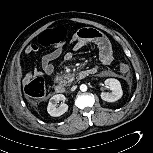 File:Acute pancreatic necrosis (Radiopaedia 13560-13486 Axial C+ portal venous phase 71).jpg
