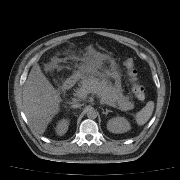 Acute pancreatitis (Radiopaedia 26663-26813 Axial non-contrast 33).jpg