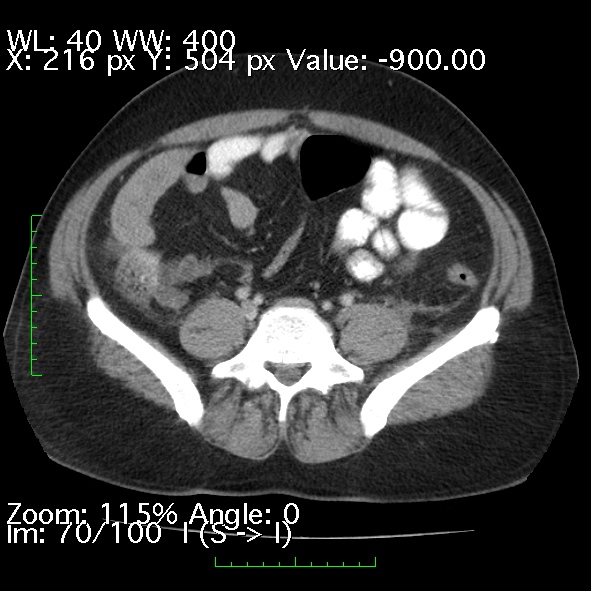 File:Acute pancreatitis (Radiopaedia 34043-35276 Axial C+ portal venous phase 70).jpg