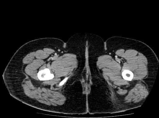 Acute pancreatitis (Radiopaedia 69236-79012 Axial C+ portal venous phase 96).jpg