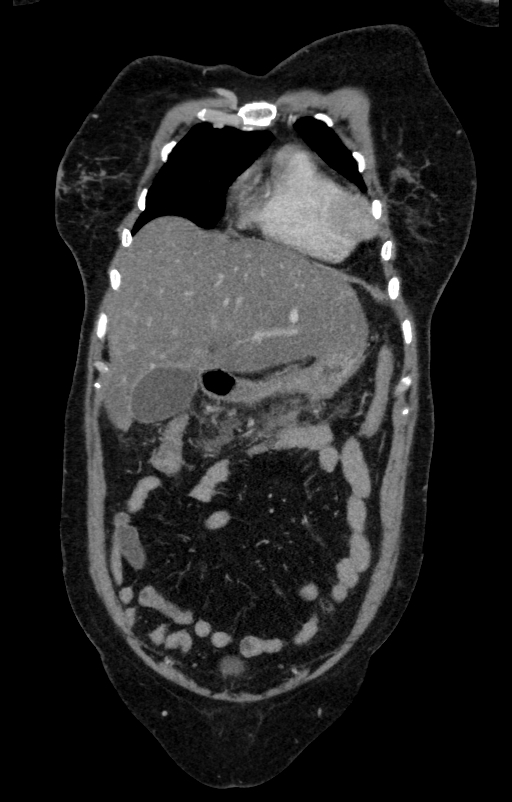 Acute pancreatitis (Radiopaedia 80007-93285 Coronal C+ portal venous phase 17).jpg