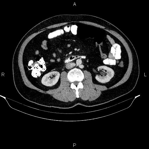 Acute pancreatitis (Radiopaedia 85390-101010 Axial C+ portal venous phase 54).jpg