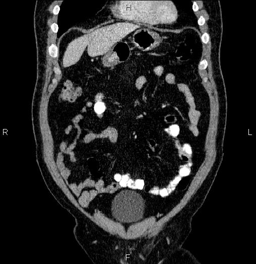 Acute pancreatitis (Radiopaedia 85390-101010 Coronal C+ portal venous phase 14).jpg