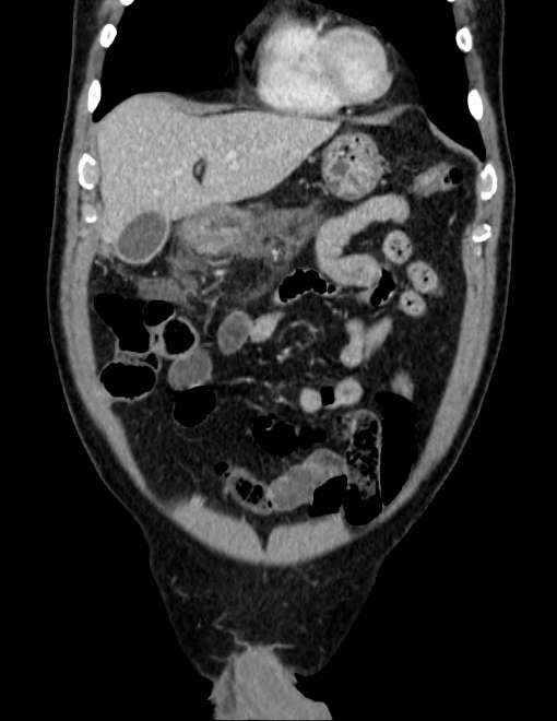 Acute pancreatitis - Balthazar E (Radiopaedia 23080-23110 Coronal C+ portal venous phase 17).jpg