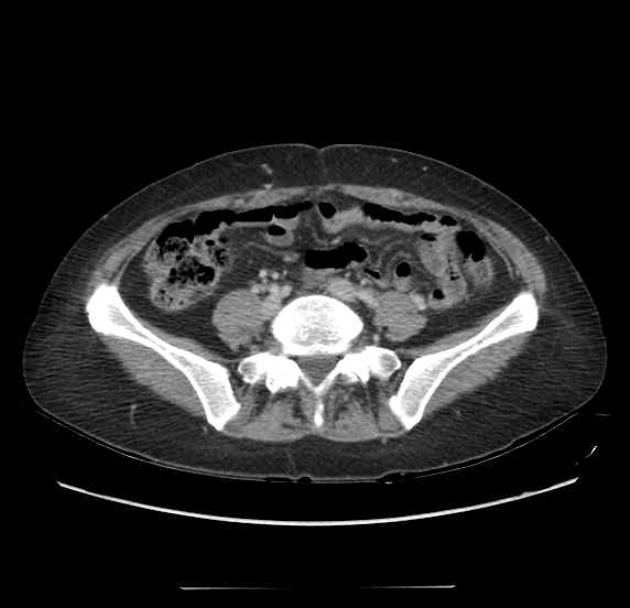 Acute pancreatitis - Balthazar E - post ERCP (Radiopaedia 27562-27772 Axial C+ portal venous phase 51).png