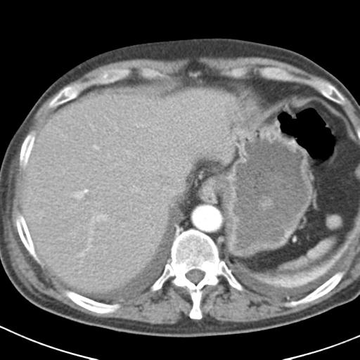 File:Acute pancreatitis and walled-off necrosis (Radiopaedia 29888-30403 Axial C+ portal venous phase 1).jpg