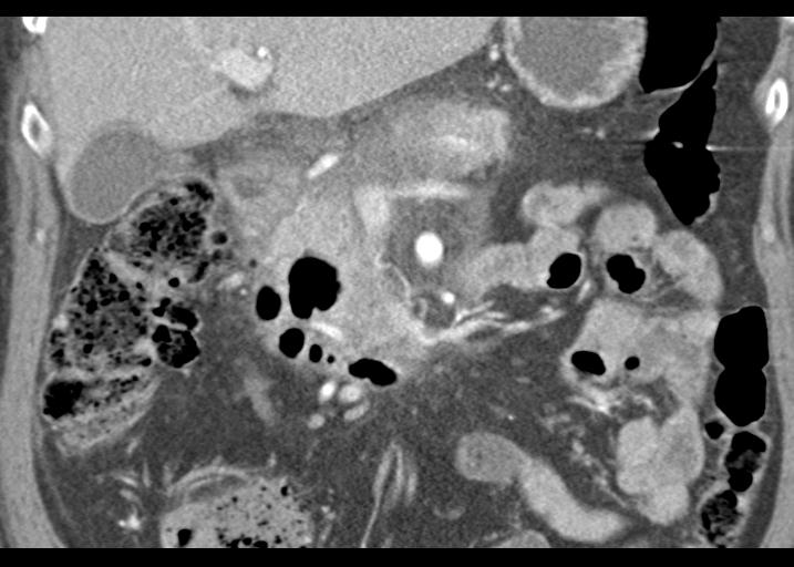 Acute pancreatitis and walled-off necrosis (Radiopaedia 29888-30403 Coronal C+ portal venous phase 25).jpg