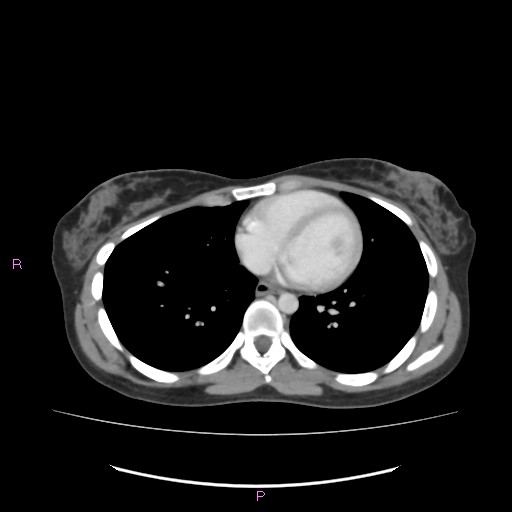 Acute pancreatitis secondary to stone at minor papilla and pancreatic divisum (Radiopaedia 76570-88333 Axial C+ portal venous phase 1).jpg