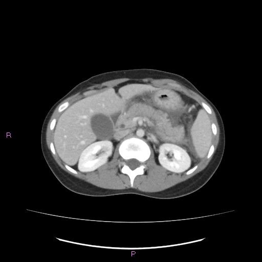 Acute pancreatitis secondary to stone at minor papilla and pancreatic divisum (Radiopaedia 76570-88333 Axial C+ portal venous phase 28).jpg