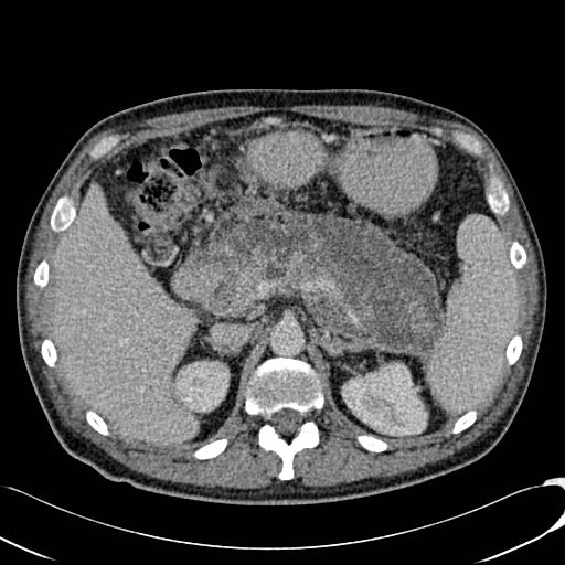 File:Acute pancreatitis with walled off pancreatic necrosis (Radiopaedia 6438-7797 Axial C+ portal venous phase 4).jpg