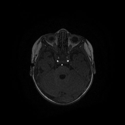Acute phase of hemiconvulsion-hemiplegia epilepsy syndrome (Radiopaedia 29309-29745 Axial TOF angiography 105).jpg