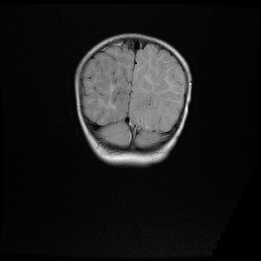 File:Acute phase of hemiconvulsion-hemiplegia epilepsy syndrome (Radiopaedia 29309-29745 Coronal FLAIR 20).jpg