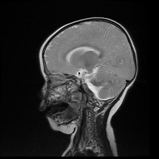 File:Acute phase of hemiconvulsion-hemiplegia epilepsy syndrome (Radiopaedia 29309-29745 Sagittal T2 13).jpg