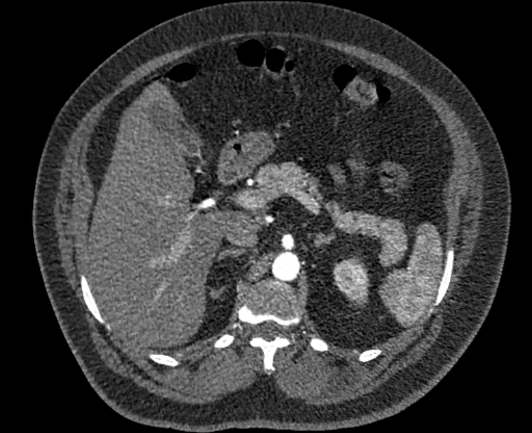 Acute pulmonary embolism with pulmonary infarcts (Radiopaedia 77688-89908 Axial C+ CTPA 80).jpg