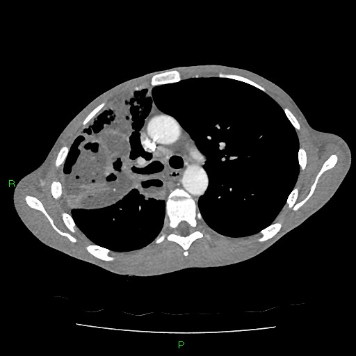 File:Acute right lung abscess (Radiopaedia 34806-36258 Axial C+ arterial phase 70).jpg