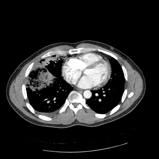 File:Acute segmental pulmonary emboli and pulmonary infarction (Radiopaedia 62264-70444 Axial C+ CTPA 74).jpg