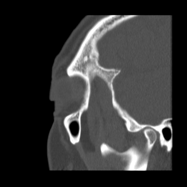 Acute sinusitis (Radiopaedia 23161-23215 Sagittal bone window 10).jpg