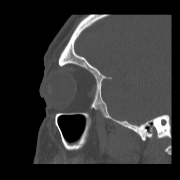 Acute sinusitis (Radiopaedia 23161-23215 Sagittal bone window 50).jpg