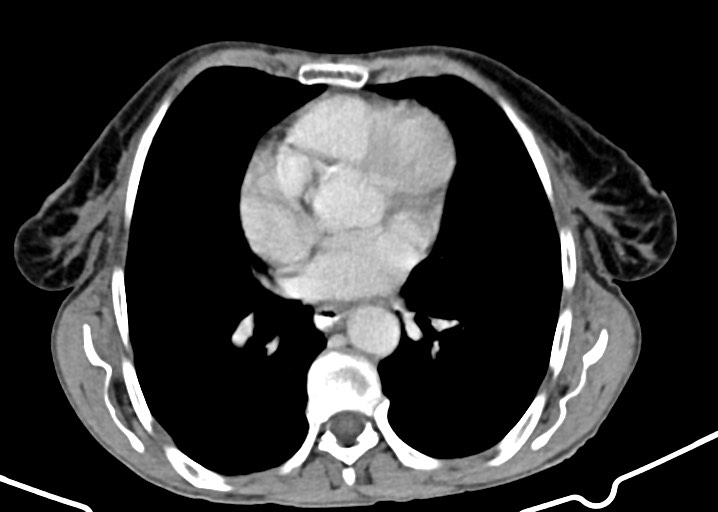 Acute small bowel (ileal) volvulus (Radiopaedia 71740-82139 Axial C+ portal venous phase 19).jpg