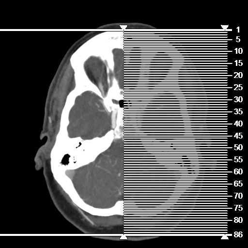 Acute subarachnoid hemorrhage and accessory anterior cerebral artery (Radiopaedia 69231-79009 Coronal C+ arterial phase 1).jpg