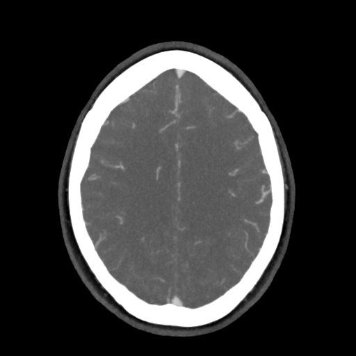 Acute subarachnoid hemorrhage and accessory anterior cerebral artery (Radiopaedia 69231-79009 D 50).jpg
