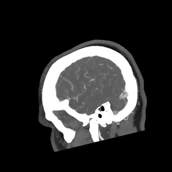 File:Acute subarachnoid hemorrhage and accessory anterior cerebral artery (Radiopaedia 69231-79009 Sagittal C+ arterial phase 15).jpg