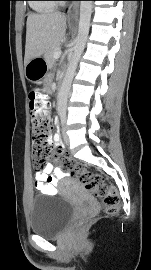 Acute uncomplicated appendicitis (Radiopaedia 61374-69304 Sagittal C+ portal venous phase 48).jpg