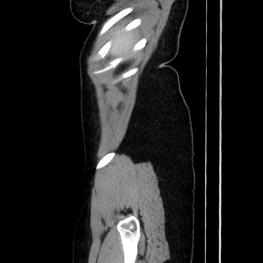 Acute uncomplicated appendicitis (Radiopaedia 73704-84499 Sagittal C+ portal venous phase 49).jpg