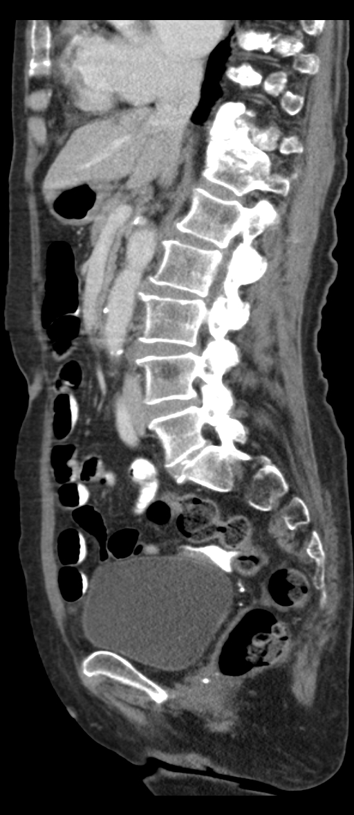 Adenocarcinoma of cecum (Radiopaedia 59222-66549 Sagittal C+ portal venous phase 51).jpg