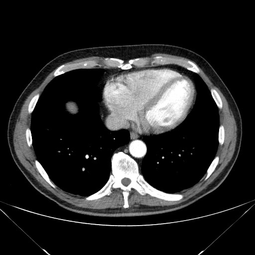 File:Adenocarcinoma of the lung (Radiopaedia 59871-67325 Axial C+ arterial phase 69).jpg