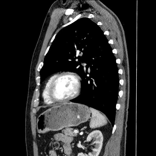 Adenocarcinoma of the lung (Radiopaedia 59871-67325 Sagittal C+ arterial phase 73).jpg