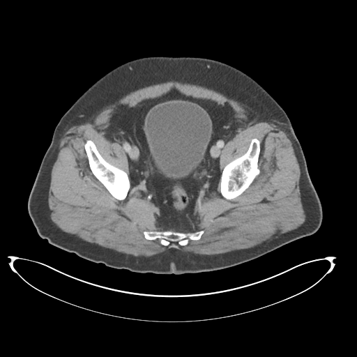 Adenocarcioma of rectum- T1 lesion (Radiopaedia 36921-38547 Axial C+ portal venous phase 76).png