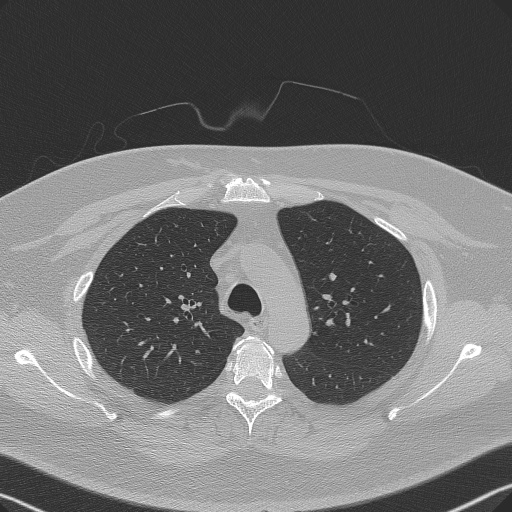 Adenoid cystic carcinoma of the trachea (Radiopaedia 49042-54137 Axial lung window 97).jpg