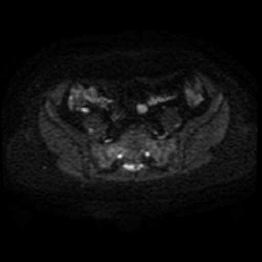 Adenoma malignum of cervix (Radiopaedia 66441-75705 Axial DWI 26).jpg