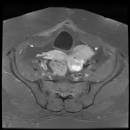 File:Adenomyosis within a didelphys uterus (Radiopaedia 70175-80215 Axial T1 C+ fat sat 20).jpg