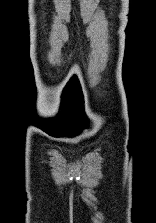 Adhesional small bowel obstruction (Radiopaedia 58900-66131 Coronal C+ portal venous phase 232).jpg