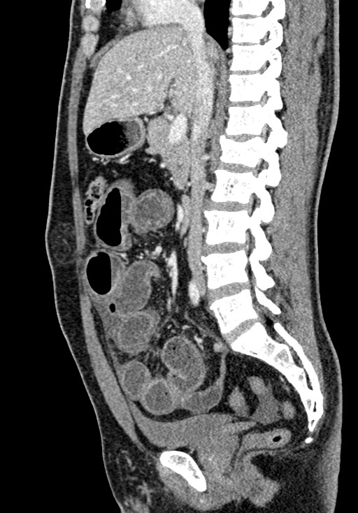 Adhesional small bowel obstruction (Radiopaedia 58900-66131 Sagittal C+ portal venous phase 115).jpg