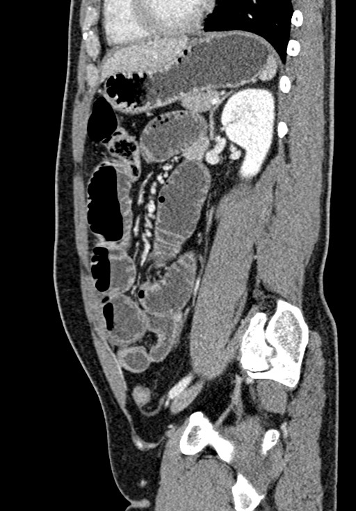 Adhesional small bowel obstruction (Radiopaedia 58900-66131 Sagittal C+ portal venous phase 162).jpg