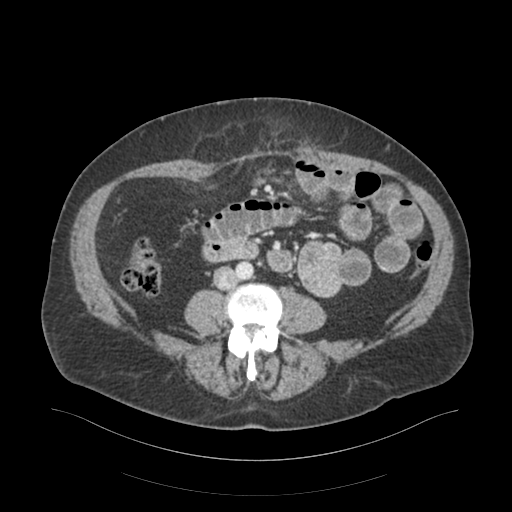 Adhesions within abdominal wall hernia (Radiopaedia 58283-65394 Coronal C+ portal venous phase 1).png