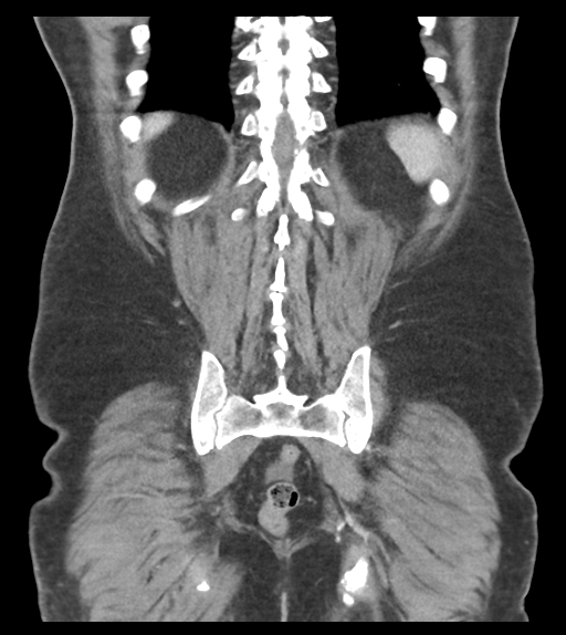 File:Adhesions within abdominal wall hernia (Radiopaedia 58283-65394 Coronal C+ portal venous phase 57).png